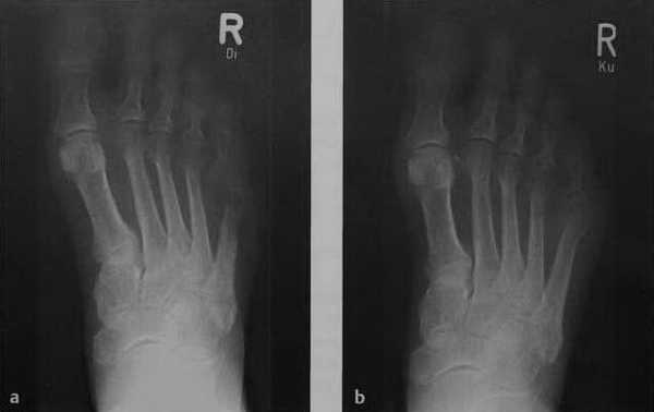 Снимки МРТ и КТ. Остеомиелит