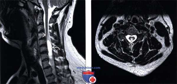 МРТ подострой комбинированной дегенерации