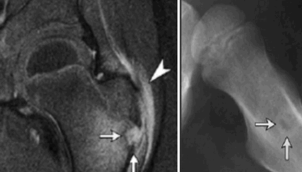 Подострый остеомиелит на МР-скане