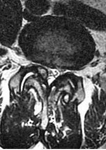 синовиальная киста