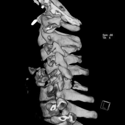 КТ позвоночника 