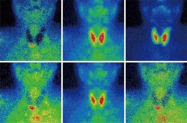 Сцинтиграфия щитовидной железы