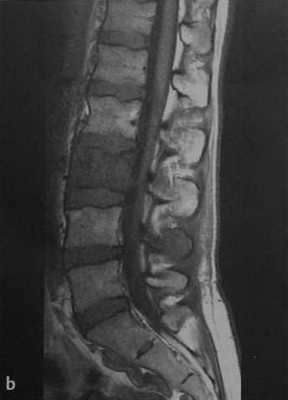 Снимки МРТ и КТ. Лимфома кости