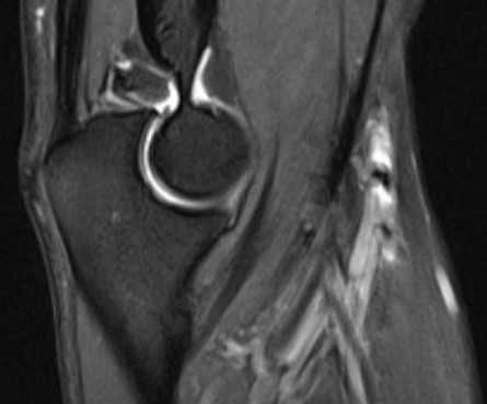 МРТ локтевого сустава в сагиттальной плоскости.