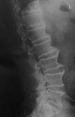 Снимки МРТ и КТ. Диффузный идиопатический гиперостоз скелета