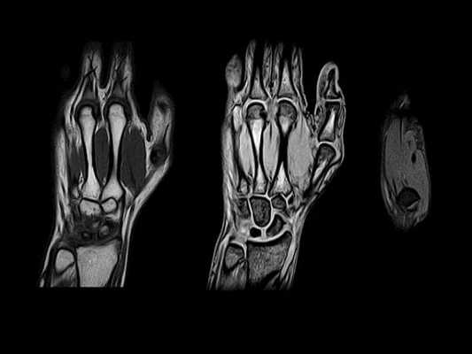 мрт кисти руки