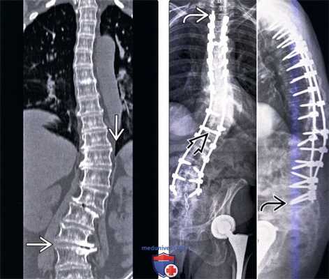 Рентгенограмма после инструментальной стабилизации сколиоза позвоночника