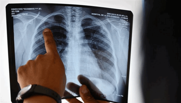 Снимок грудной клетки