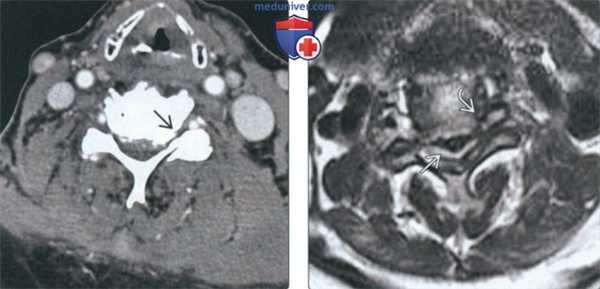Рентгенограмма, КТ, МРТ при артрозе дугоотростчатых суставов шейных позвонков