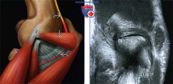 Признаки надблоково-локтевой мышцы