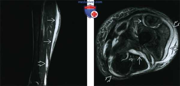 Некротизирующий фасциит - лучевая диагностика