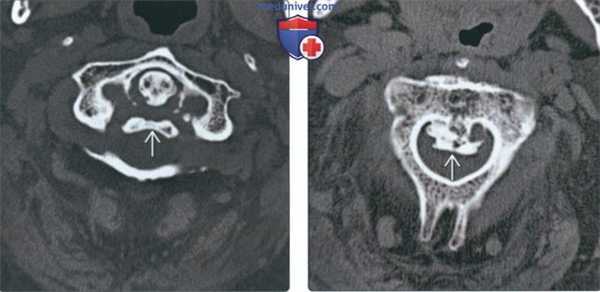 Рентгенограмма, КТ, МРТ при диффузном идиопатическом скелетном гиперостозе
