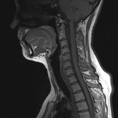 шейный отдел позвоночника на МРТ