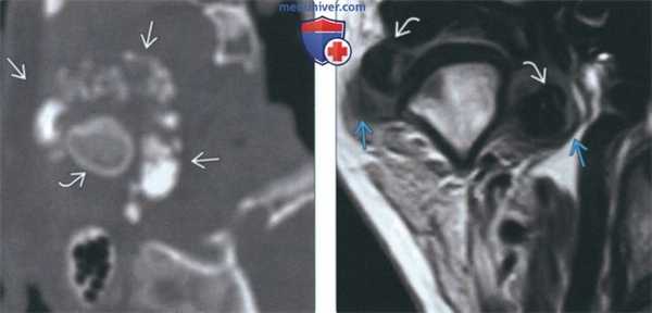 КТ, МРТ при первичном синовиальном хондроматозе височно-нижнечелюстного сустава (ВНЧС)