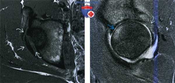 Рентгенограмма, КТ, МРТ при вывихе бедра
