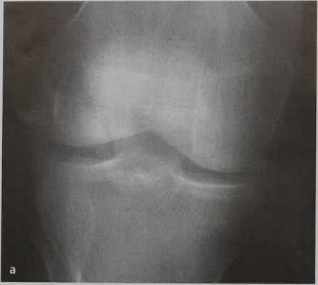 Снимки МРТ и КТ. Перелом надколенника