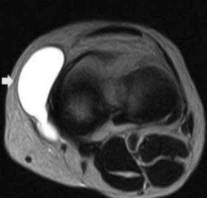 Бурсит коленного сустава