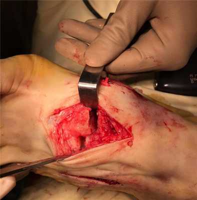 вывих в суставе Лисфранка операция