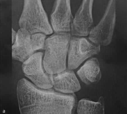 Снимки МРТ и КТ. Перелом ладьевидной кости