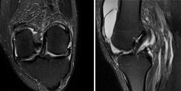 Нормальная анатомия коленного сустава на МРТ