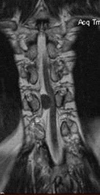 Опухоль на МРТ шейного отдела позвоночника