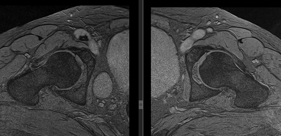 Заболевания тазобедренного сустава, что выявляет МРТ