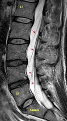 mrt-poyasnicy-parasagittalno