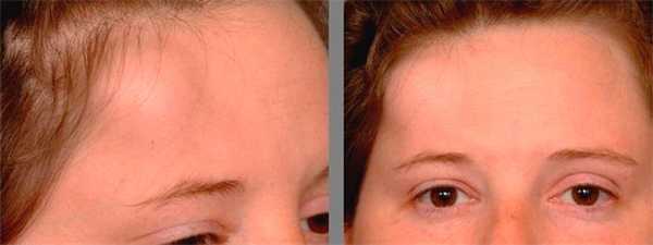 Остеома лобной кости