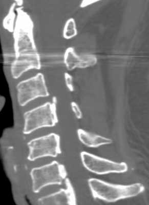 Японская болезнь-КТ