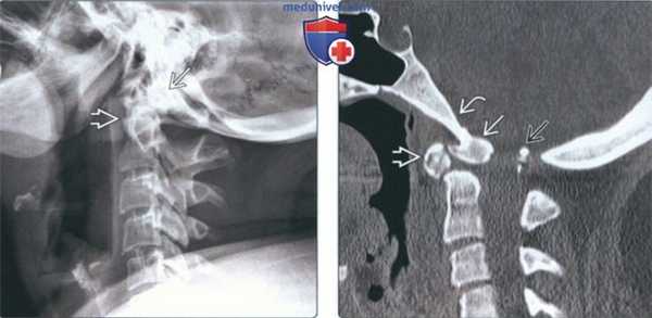 Лучевая диагностика птичьей кости