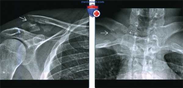 Признаки перелома ключицы