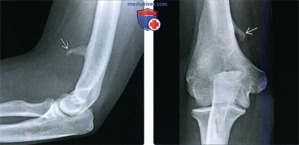 Рентгенограмма, КТ, МРТ при повреждении срединного нерва