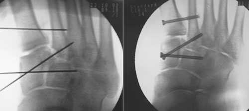 лечение вывиха Лисфранка