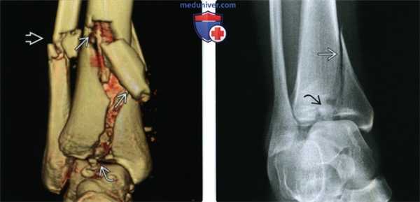 Рентгенограмма, КТ, МРТ при переломе дистального метаэпифиза большеберцовой кости