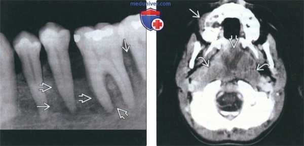 Рентгенограмма, КТ, МРТ при лимфоме Беркитта челюсти