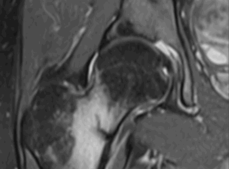 Стресс-перелом шейки бедра на МРТ