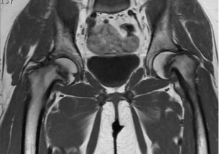 Эпифизеолиз бедер на МРТ