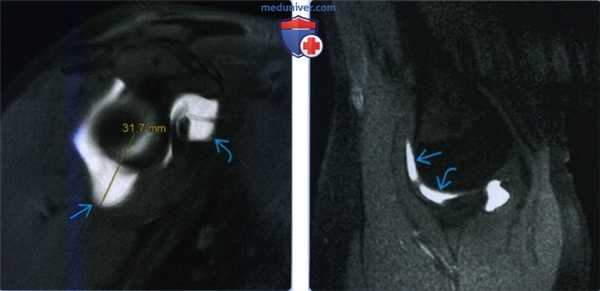 Признаки разнонаправленной нестабильности плечевого сустава