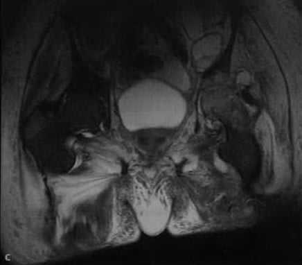 Снимки МРТ и КТ. Септический артрит