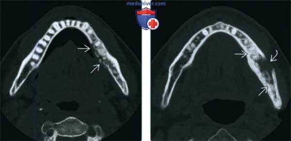 Остеонекроз верхней и нижней челюсти - лучевая диагностика