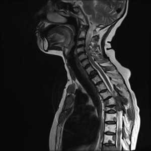 метастазы-Т2