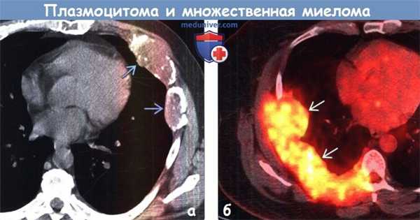 Плазмоцитома и множественная миелома на КТ, ПЭТ органов грудной клетки