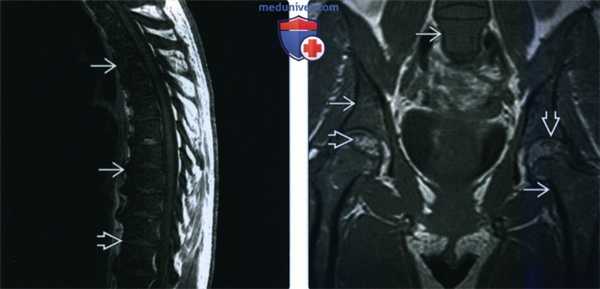 Рентгенограмма, КТ, МРТ при костных проявлениях лейкемии