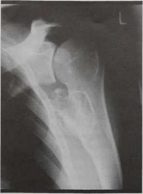 Снимки МРТ и КТ. Остеохондрома