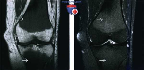 Рентгенограмма, КТ, МРТ при костных проявлениях лейкемии