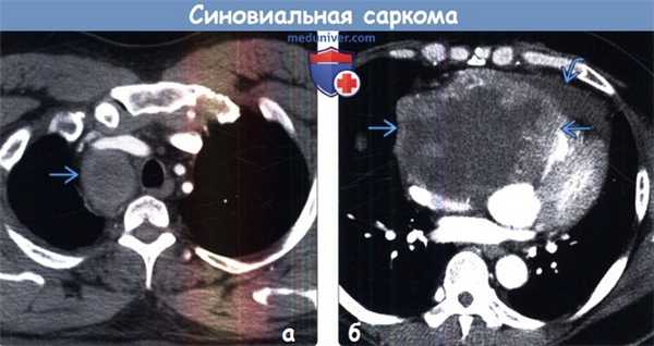 Синовиальная саркома на КТ