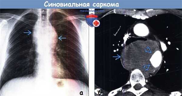 Синовиальная саркома на рентгенограмме, КТ