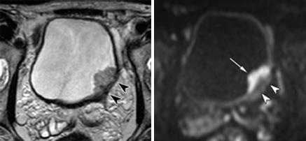 МРТ малого таза в диагностике заболеваний мочевого пузыря