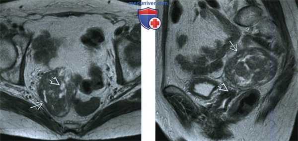 КТ, МРТ, УЗИ при паразитирующей миоме