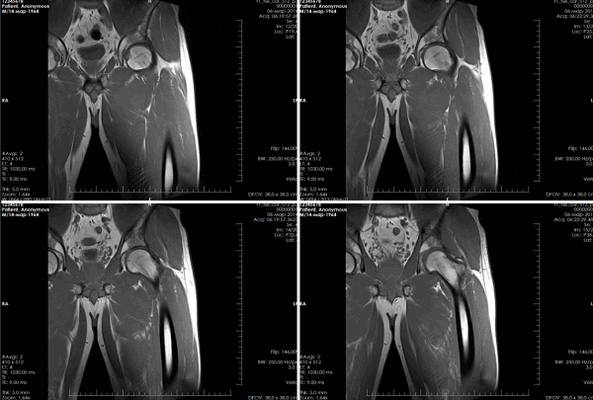 МРТ тазобедренного сустава